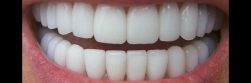 Why having white teeth is important to all?